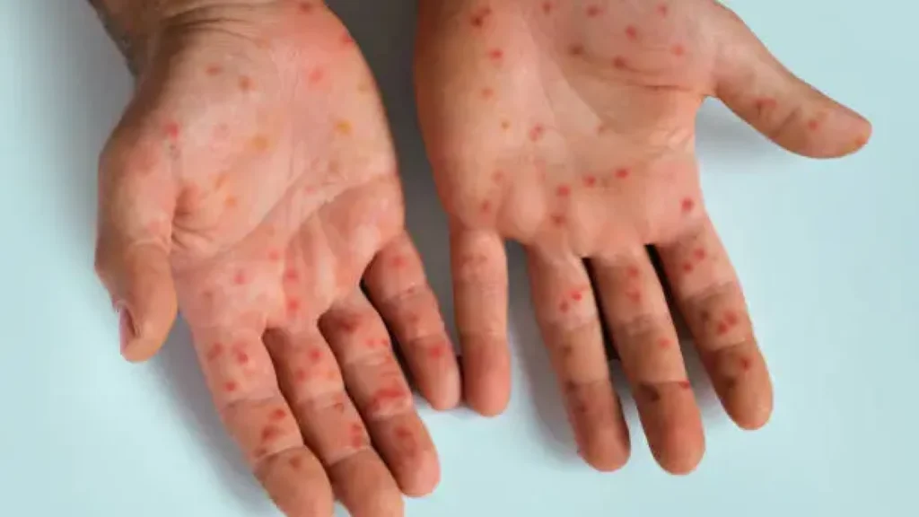 Mpox Ditetapkan sebagai Darurat Kesehatan Global, Kasus Meningkat di Indonesia